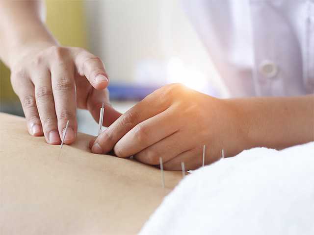 Close up of hands on a person's back with acupuncture needles sticking in it