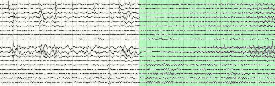 Epilepsy Fellowship